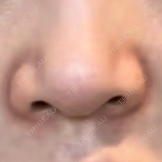 その他（鼻） LE CLINIC DAY 39 メイン用