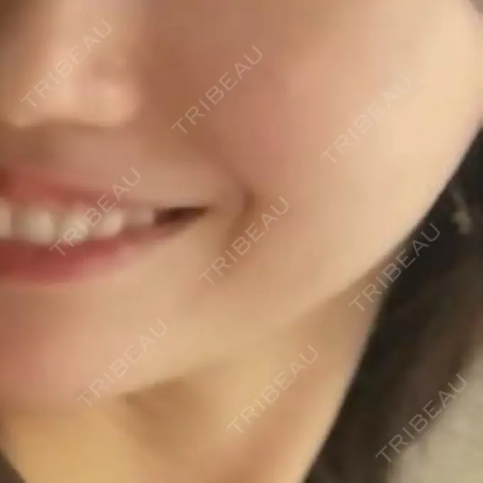 ボトックス（エラ・小顔） TCB東京中央美容外科 自由が丘院 DAY 7 メイン用