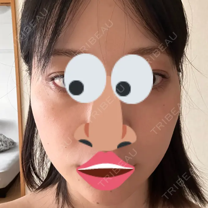 ボトックス（エラ・小顔） / ルメッカ Code Beauty Clinic 名古屋院 AFTER メイン用