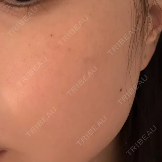 ボトックス（エラ・小顔） / ルメッカ Code Beauty Clinic 名古屋院 DAY 1 メイン用