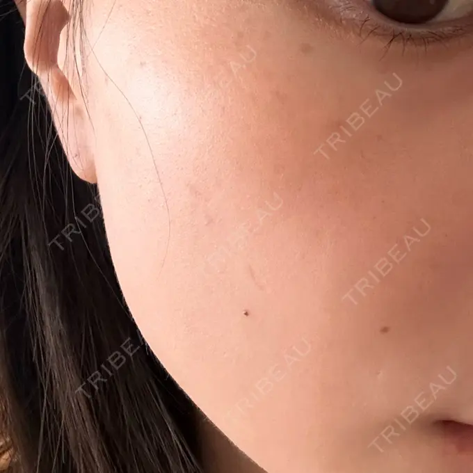 ボトックス（エラ・小顔） / ルメッカ Code Beauty Clinic 名古屋院 DAY 1 メイン用