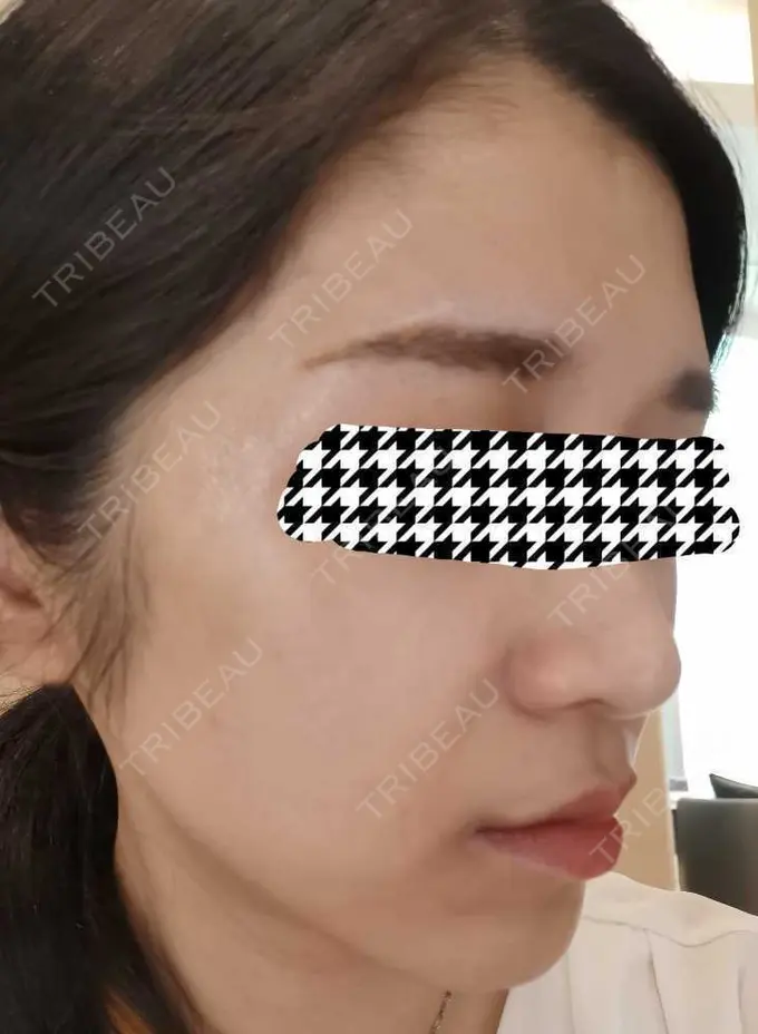 エレクトロポレーション / ルメッカ CZEN CLINIC 銀座院 DAY 0 メイン用