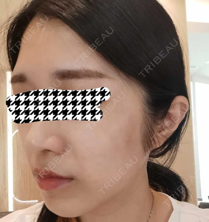 エレクトロポレーション / ルメッカ CZEN CLINIC 銀座院 AFTER メイン用