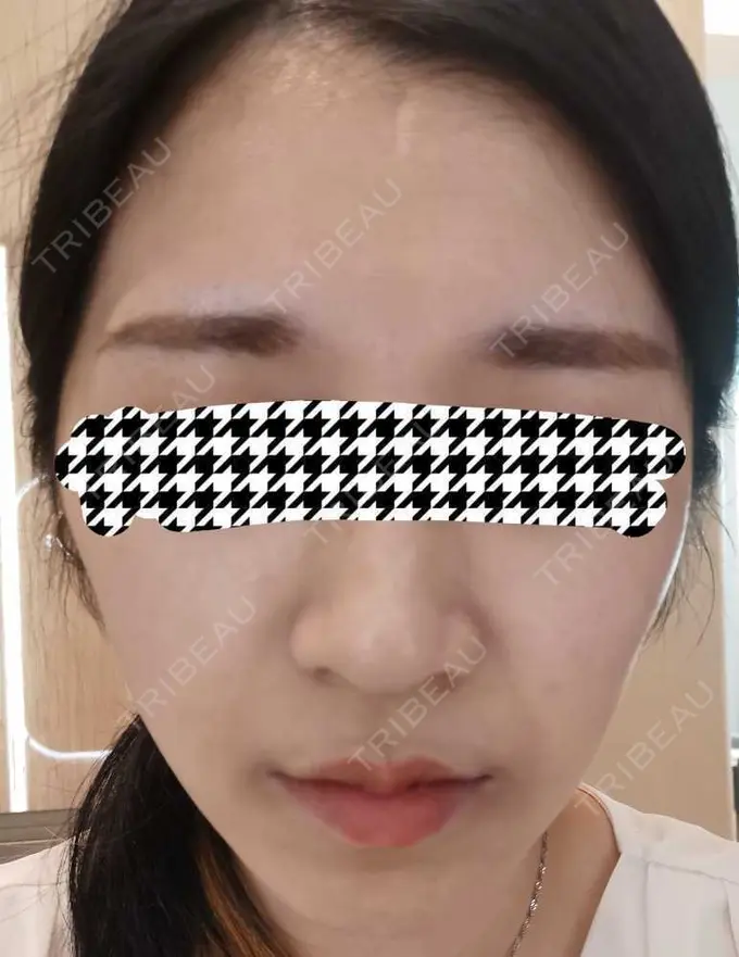 エレクトロポレーション / ルメッカ CZEN CLINIC 銀座院 DAY 0 メイン用