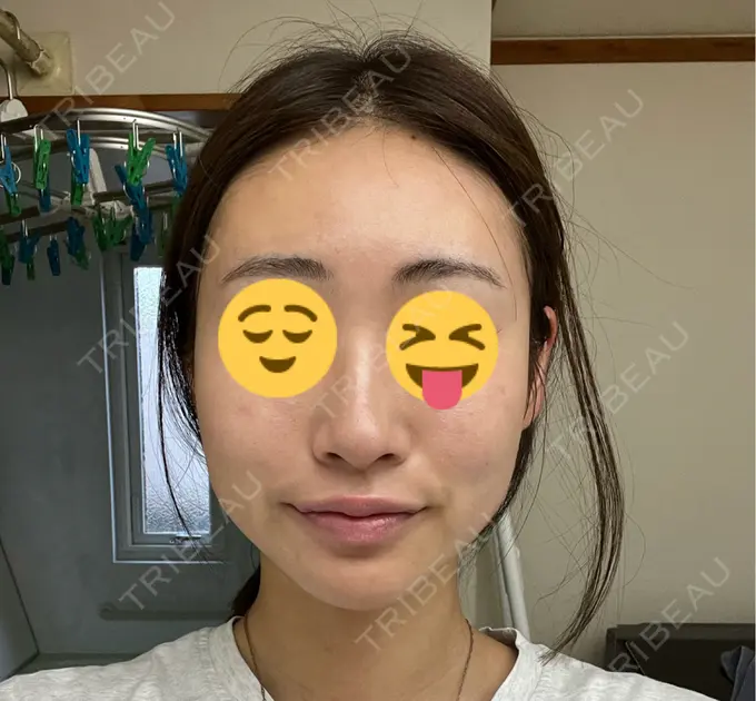 ボトックス（エラ・小顔） / ハイフ（顔） LOUIS CLINIC 二子玉川院【ルイクリニック】 AFTER メイン用