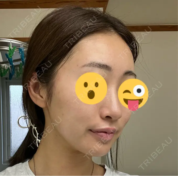 ボトックス（エラ・小顔） / ハイフ（顔） LOUIS CLINIC 二子玉川院【ルイクリニック】 DAY 0 メイン用