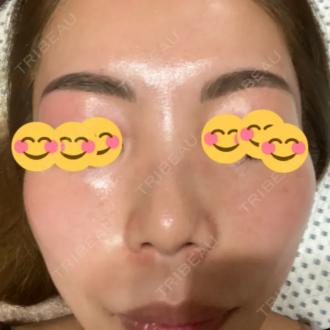 ピーリング（ニキビ・毛穴） / 美肌レーザー / シミ取りレーザー / 美白レーザー / 毛穴洗浄（ハイドラフェイシャルなど） / ピコレーザートーニング（美白・肝斑） / レーザートーニング（美白・肝斑） / ピーリング（ハリ・ツヤ） LE CLINIC DAY 6 メイン用