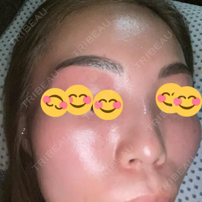 ピーリング（ニキビ・毛穴） / 美肌レーザー / シミ取りレーザー / 美白レーザー / 毛穴洗浄（ハイドラフェイシャルなど） / ピコレーザートーニング（美白・肝斑） / レーザートーニング（美白・肝斑） / ピーリング（ハリ・ツヤ） LE CLINIC DAY 6 メイン用