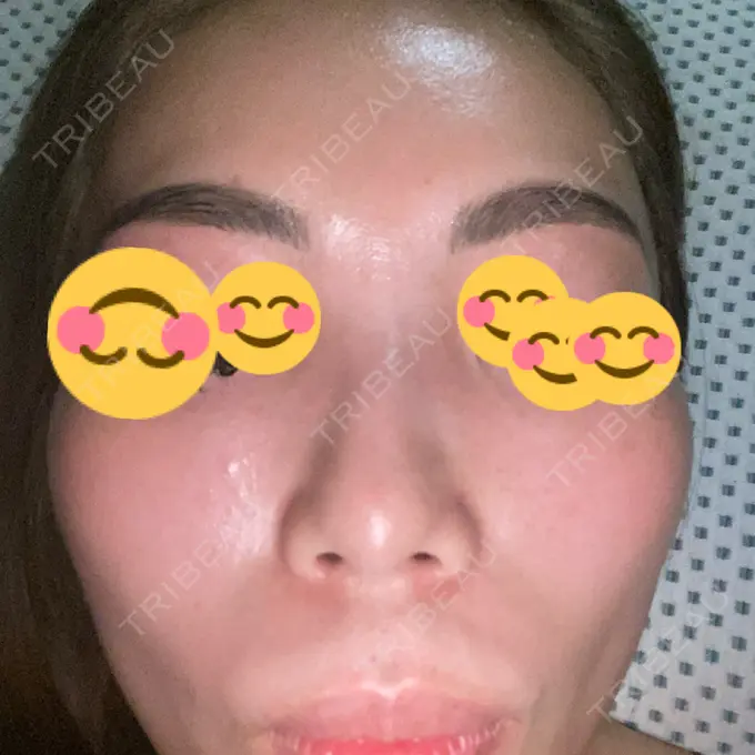 ピーリング（ニキビ・毛穴） / 美肌レーザー / シミ取りレーザー / 美白レーザー / 毛穴洗浄（ハイドラフェイシャルなど） / ピコレーザートーニング（美白・肝斑） / レーザートーニング（美白・肝斑） / ピーリング（ハリ・ツヤ） LE CLINIC DAY 7 メイン用