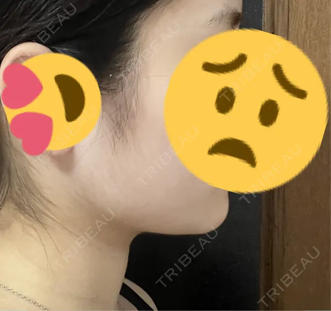 脂肪吸引（顔） Mods Clinic（モッズクリニック） 名古屋院 DAY 109 メイン用