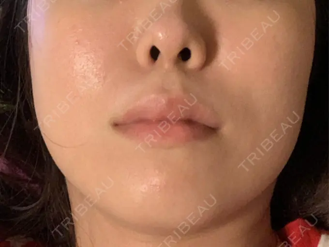 レーザーフェイシャル LIGHT CLINIC 【ライトクリニック】 新宿院 DAY 1 メイン用