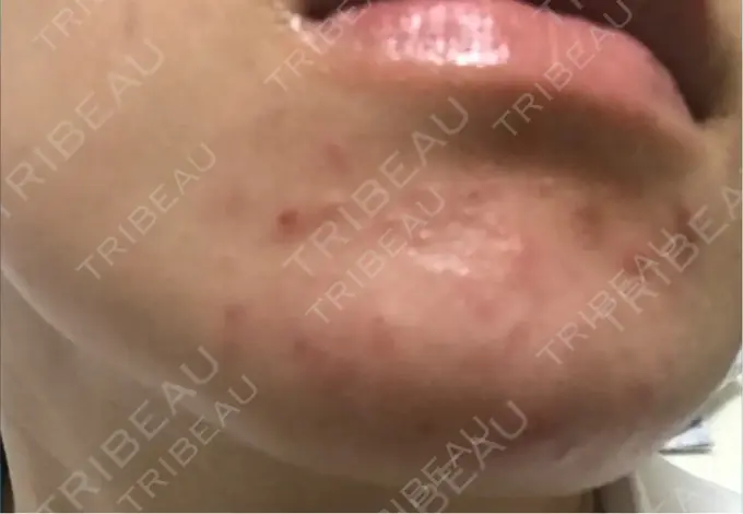 ピーリング（ニキビ・毛穴） / イオン導入 渋谷美容外科クリニック 渋谷院 AFTER メイン用