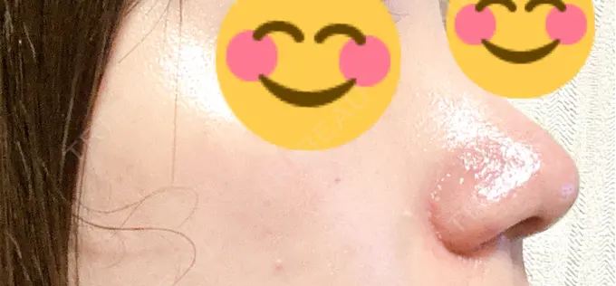 鼻尖形成（切開） / 軟骨移植 / 鼻翼挙上 / 鼻修正 / その他（鼻） 東京シンデレラ美容外科 大宮院 AFTER メイン用