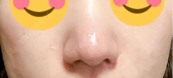 鼻尖形成（切開） / 軟骨移植 / 鼻翼挙上 / 鼻修正 / その他（鼻） 東京シンデレラ美容外科 大宮院 DAY 33 メイン用