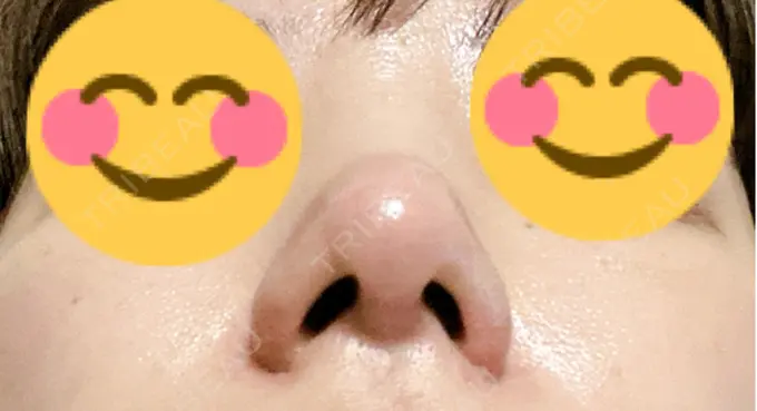 鼻尖形成（切開） / 軟骨移植 / 鼻翼挙上 / 鼻修正 / その他（鼻） 東京シンデレラ美容外科 大宮院 DAY 33 メイン用