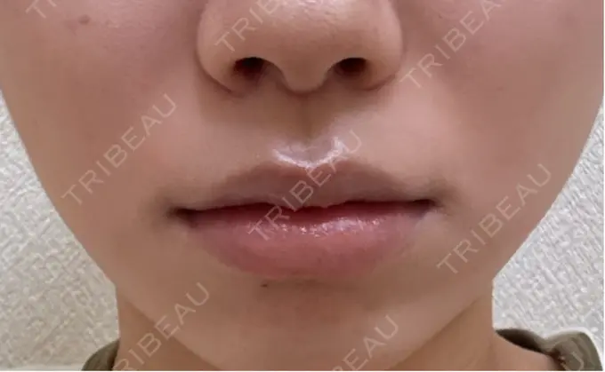 人中短縮 もとび美容外科クリニック 新宿院 DAY 26 メイン用