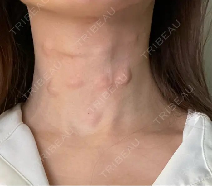 その他（肌） コスメディカルクリニック シンシア 銀座院 AFTER メイン用