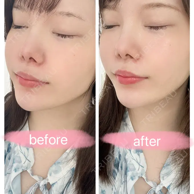 白玉点滴・注射 / 再生医療 渋谷美容外科クリニック 渋谷院 AFTER メイン用