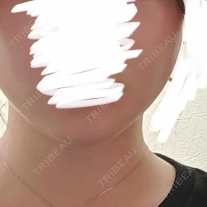 脂肪吸引注射（顔） 東京シンデレラ美容外科 池袋院 DAY 31 メイン用