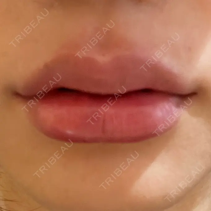 ヒアルロン酸注入（唇） R Beauty CLINIC 銀座院 DAY 0 メイン用