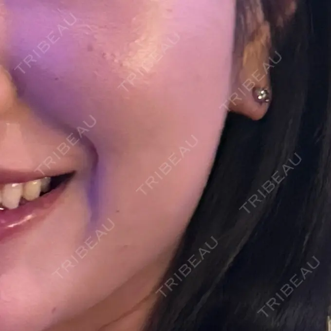 ボトックス（エラ・小顔） TCB東京中央美容外科 自由が丘院 AFTER メイン用