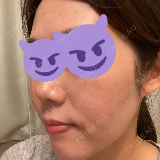 美肌レーザー / シミ取りレーザー / ピコレーザートーニング（美白・肝斑） / フラクショナルレーザー（毛穴・ニキビ跡） / YAGレーザー / レーザートーニング（美白・肝斑） / 赤み除去レーザー / ピコフラクショナルレーザー（毛穴・ニキビ跡） AI Beauty Clinic （エーアイ美容クリニック） AFTER メイン用