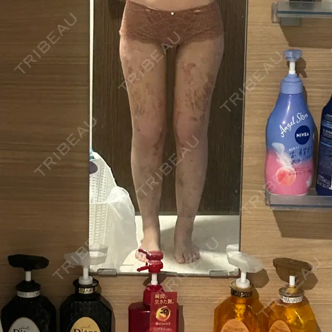 脂肪吸引（脚） Mods Clinic（モッズクリニック） 名古屋院 DAY 12 メイン用