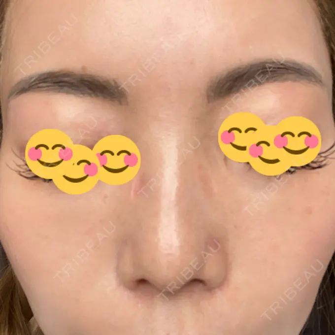 ピーリング（ニキビ・毛穴） / 美肌レーザー / シミ取りレーザー / 美白レーザー / 毛穴洗浄（ハイドラフェイシャルなど） / ピコレーザートーニング（美白・肝斑） / レーザートーニング（美白・肝斑） / ピーリング（ハリ・ツヤ） LE CLINIC AFTER メイン用