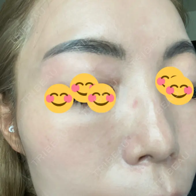 ピーリング（ニキビ・毛穴） / 美肌レーザー / シミ取りレーザー / 美白レーザー / 毛穴洗浄（ハイドラフェイシャルなど） / ピコレーザートーニング（美白・肝斑） / レーザートーニング（美白・肝斑） / ピーリング（ハリ・ツヤ） LE CLINIC DAY 10 メイン用