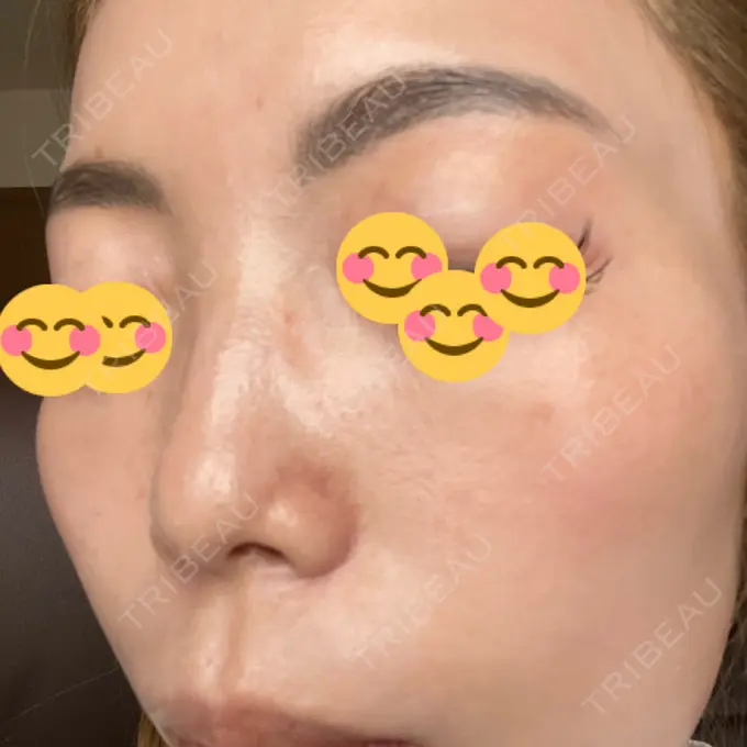 ピーリング（ニキビ・毛穴） / 美肌レーザー / シミ取りレーザー / 美白レーザー / 毛穴洗浄（ハイドラフェイシャルなど） / ピコレーザートーニング（美白・肝斑） / レーザートーニング（美白・肝斑） / ピーリング（ハリ・ツヤ） LE CLINIC DAY 9 メイン用