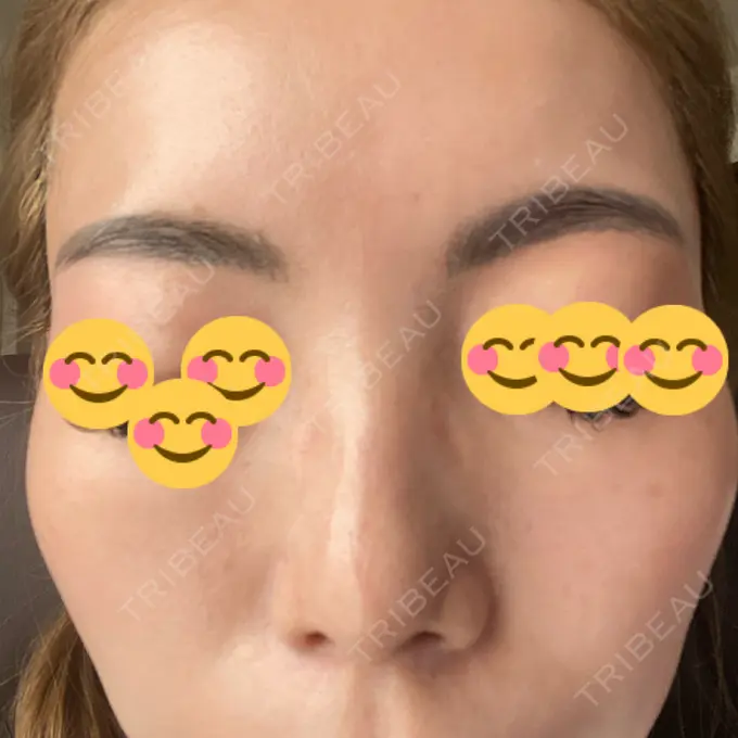 ピーリング（ニキビ・毛穴） / 美肌レーザー / シミ取りレーザー / 美白レーザー / 毛穴洗浄（ハイドラフェイシャルなど） / ピコレーザートーニング（美白・肝斑） / レーザートーニング（美白・肝斑） / ピーリング（ハリ・ツヤ） LE CLINIC DAY 8 メイン用