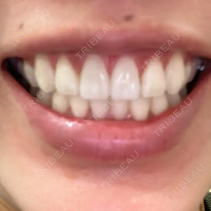 ホワイトニング LEAGRANT CLINIC 中目黒 DAY 0 メイン用