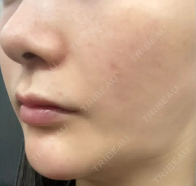 ほくろ・いぼ切除（肌） バログ医院 江南院 DAY 171 メイン用