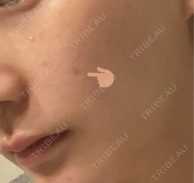 ほくろ・いぼ切除（肌） バログ医院 江南院 DAY 181 メイン用