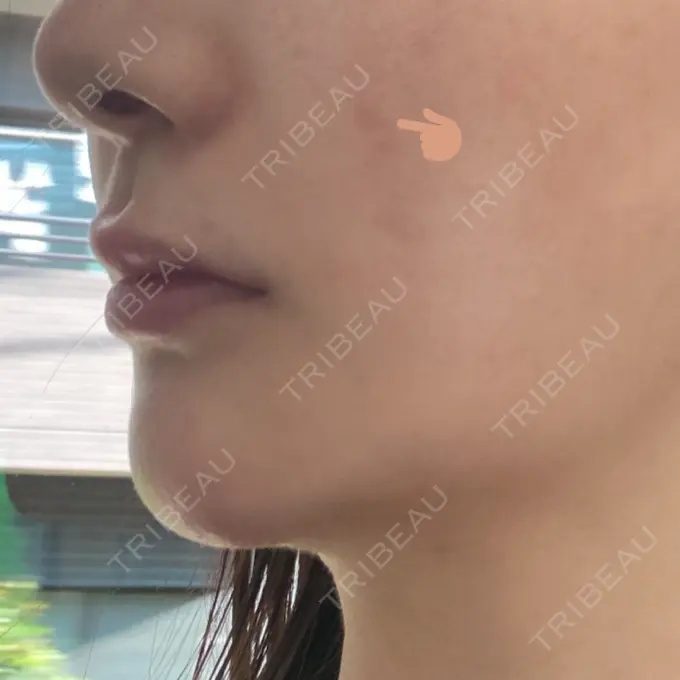 ほくろ・いぼ切除（肌） バログ医院 江南院 AFTER メイン用