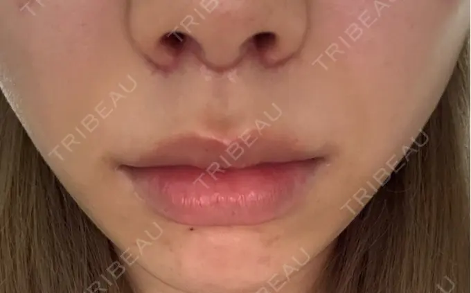 人中短縮 もとび美容外科クリニック 新宿院 DAY 28 メイン用