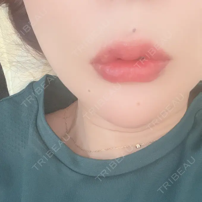 ヒアルロン酸注入（唇） / ボトックス（口角） ルラ美容クリニック 神戸院 AFTER メイン用