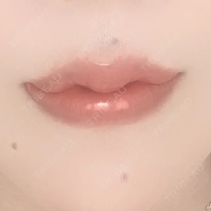 ヒアルロン酸注入（唇） / ボトックス（口角） ルラ美容クリニック 神戸院 DAY 2 メイン用