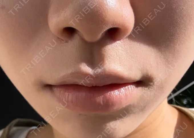 人中短縮 もとび美容外科クリニック 新宿院 DAY 29 メイン用