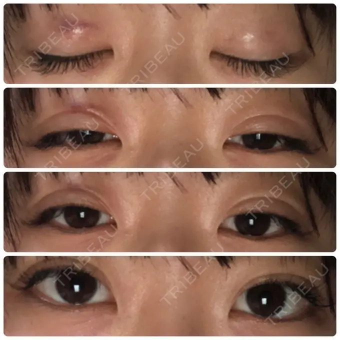 二重埋没 湘南美容クリニック 長野院 DAY 6 メイン用