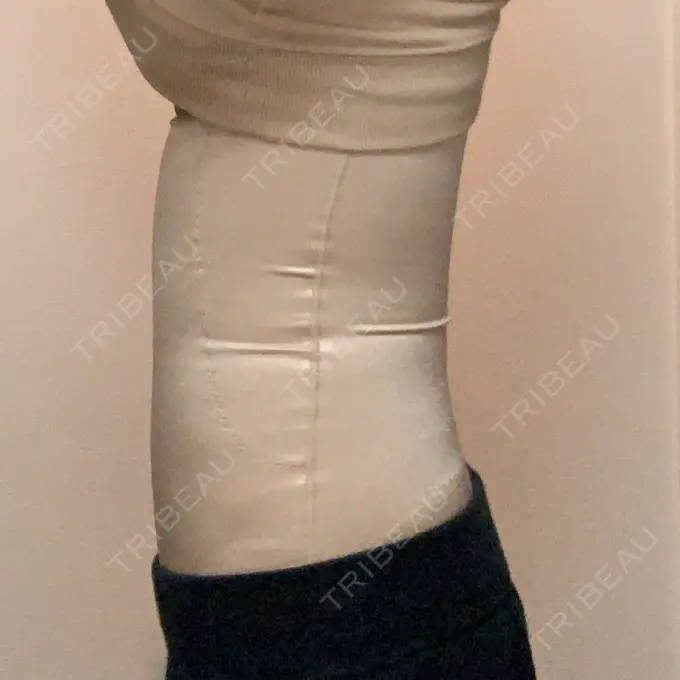 脂肪吸引（二の腕） / 脂肪吸引（お腹） ドクターフィット（Dr.fit）クリニック DAY 5 メイン用