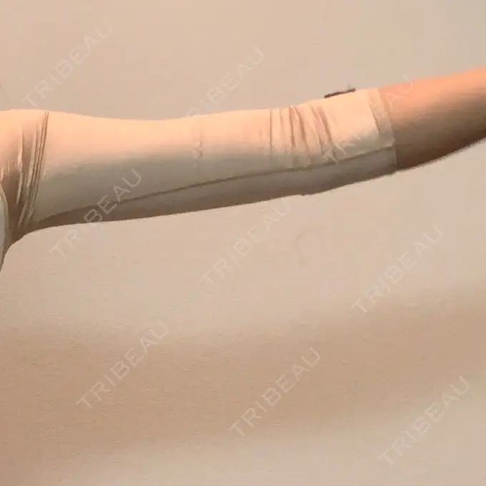 脂肪吸引（二の腕） / 脂肪吸引（お腹） ドクターフィット（Dr.fit）クリニック DAY 5 メイン用