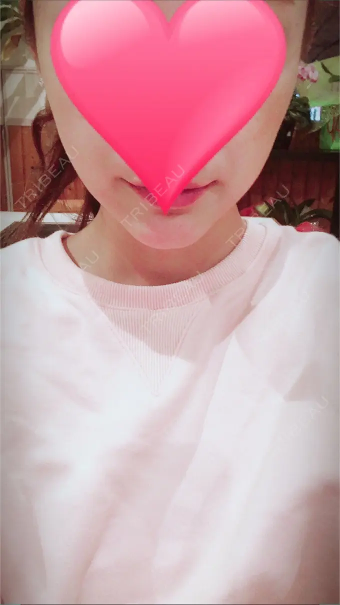 あごプロテーゼ ジュエリー美容外科 DAY 23 メイン用