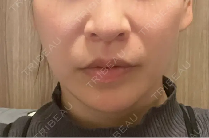 小鼻縮小（切開） / 人中短縮 Otus Clinic 【オータスクリニック】 DAY 91 メイン用