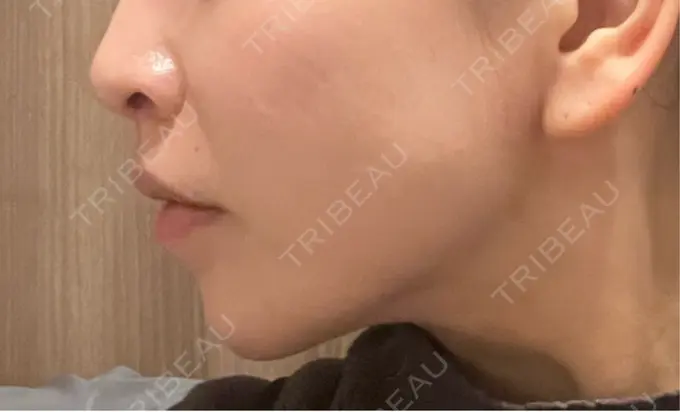 小鼻縮小（切開） / 人中短縮 Otus Clinic 【オータスクリニック】 DAY 91 メイン用