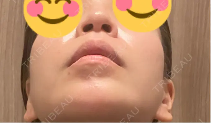 小鼻縮小（切開） / 人中短縮 Otus Clinic 【オータスクリニック】 DAY 91 メイン用