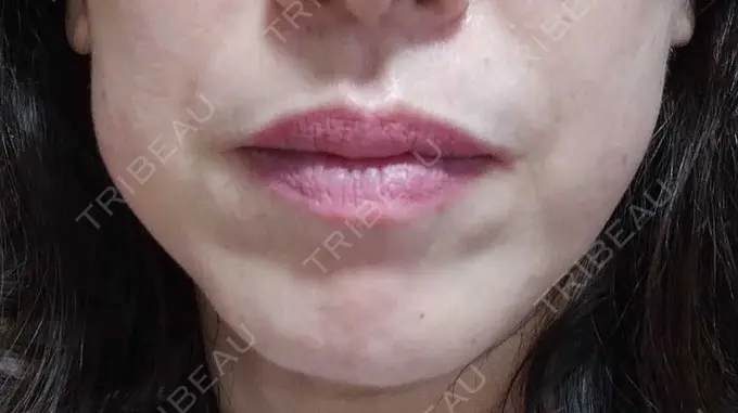 ボトックス（エラ・小顔） TCB東京中央美容外科 金山院 DAY 58 メイン用