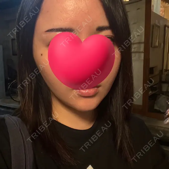 糸リフト / バッカルファット除去 / 脂肪吸引（顔） RIVER CLINIC（リバークリニック） AFTER メイン用