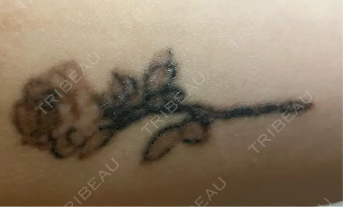 タトゥー除去 ルラ美容クリニック 福岡本院 AFTER メイン用