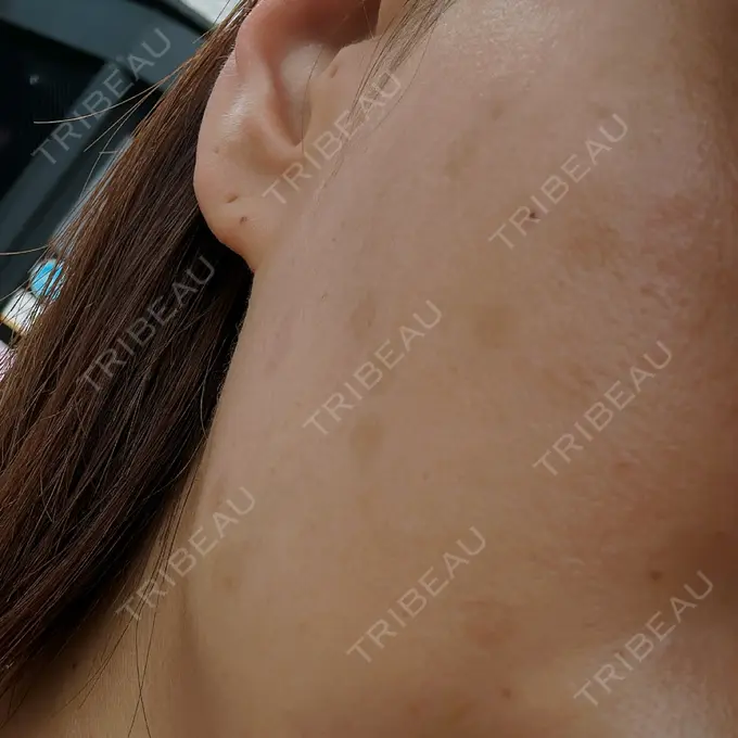 ピコレーザートーニング（美白・肝斑） G MEDICAL ART クリニック 新宿院 DAY 77 メイン用